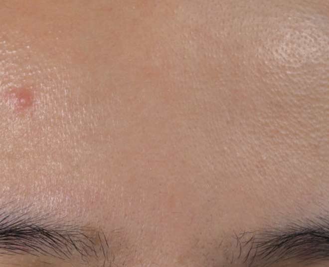 Blind Pimple