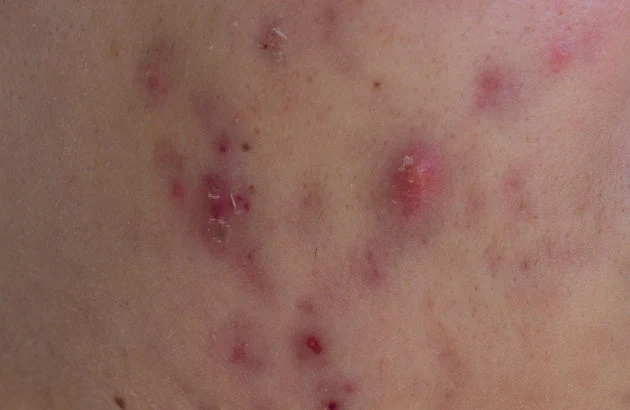 Cystic Pimples