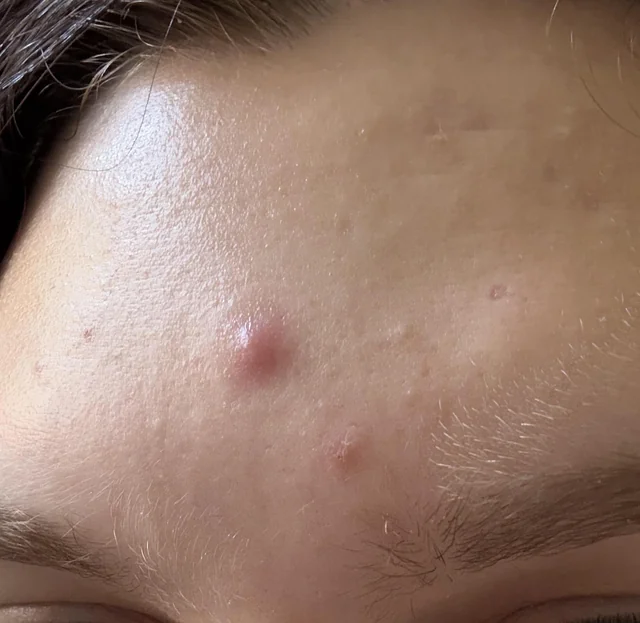 Blind Pimple