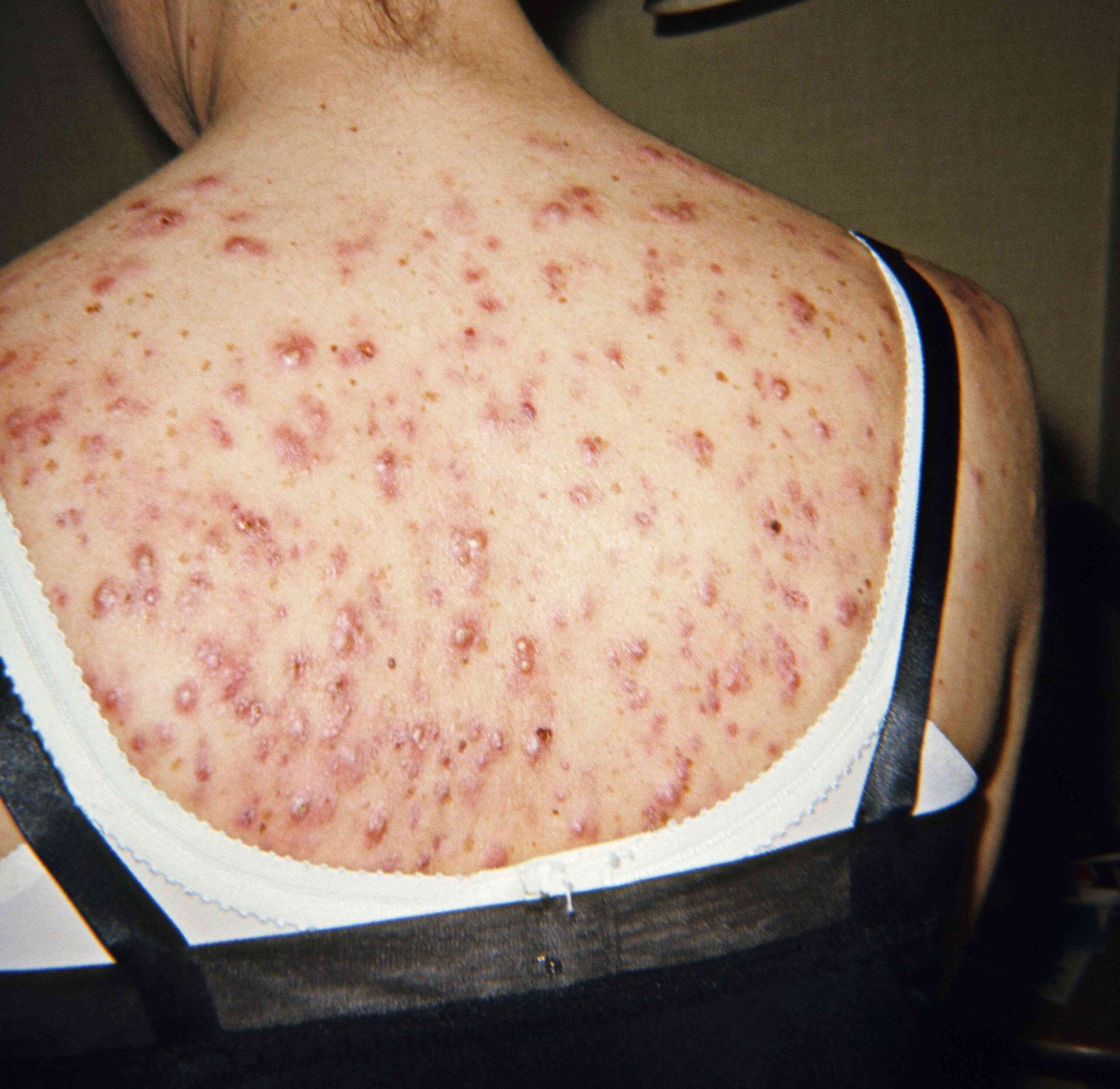 Cystic Pimple